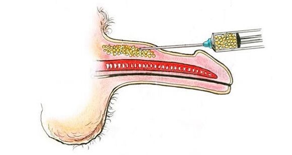 Injekcije hialuronske kisline v sod člana, da bi ga povečali